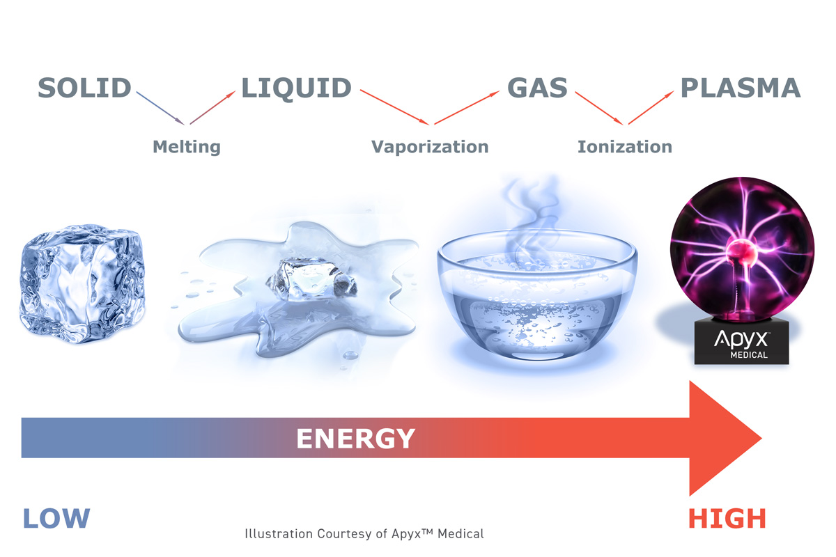 Illustration of how J Plasma Body Contouring works