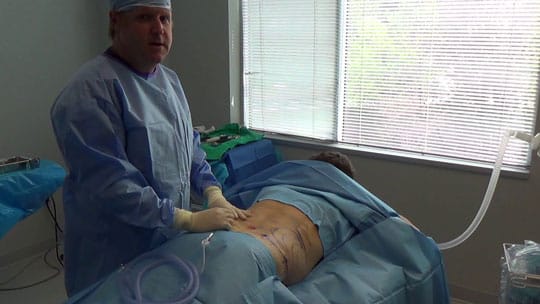 Liposuction Videos