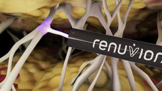 Renuvion J-Plasma