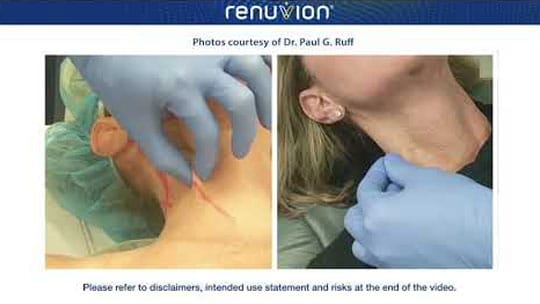 Renuvion J-Plasma