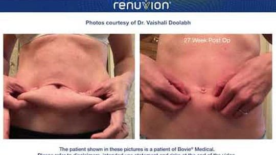 Renuvion J-Plasma
