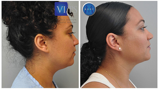Before and after neck liposuction in Northern Virginia at LITTLE Lipo