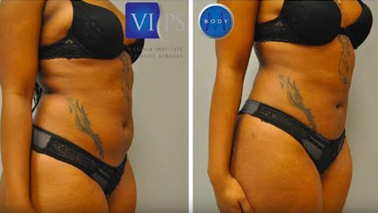 Before and after treatments at LITTLE Lipo