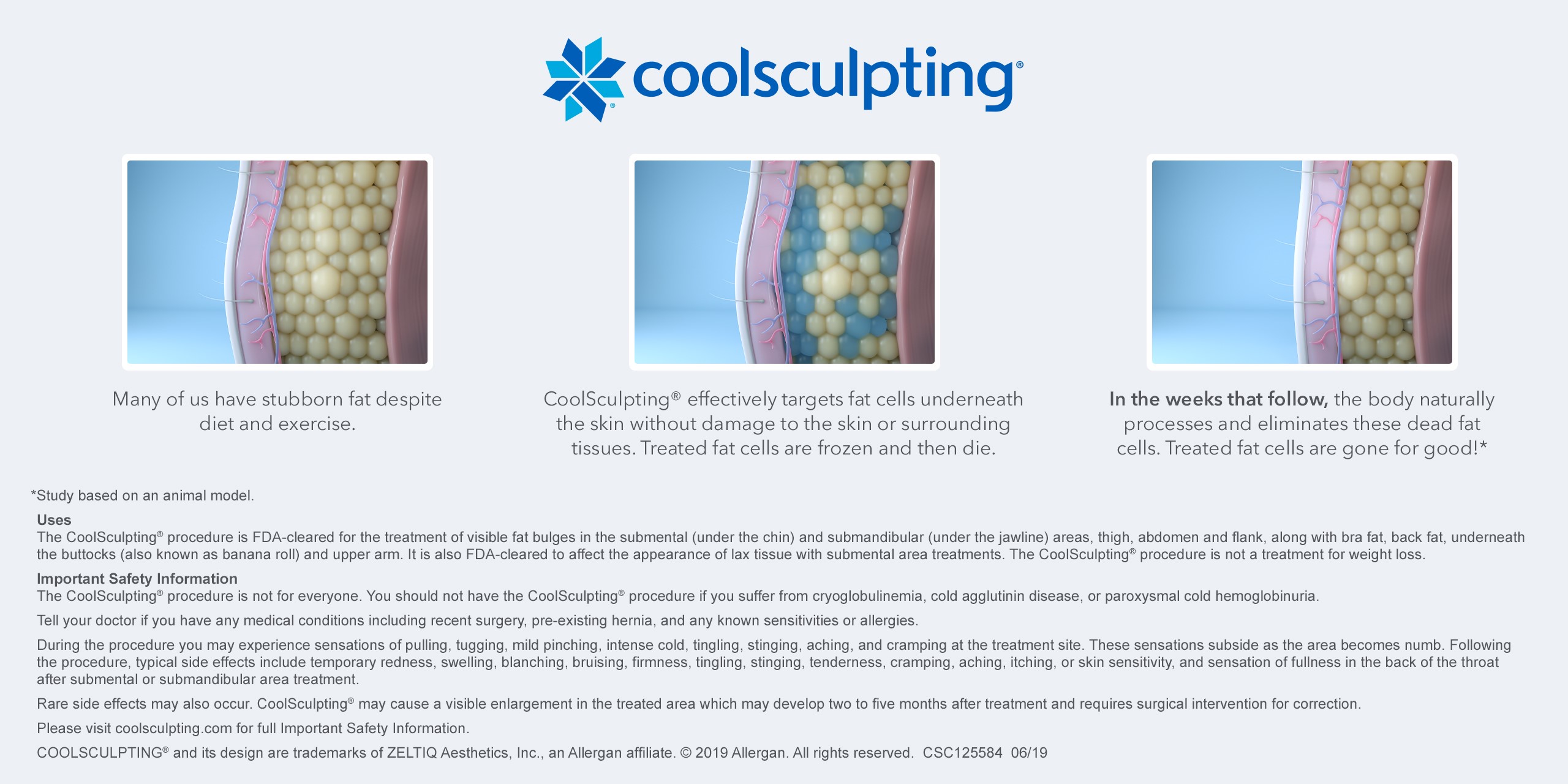 how coolsculpting works infographic