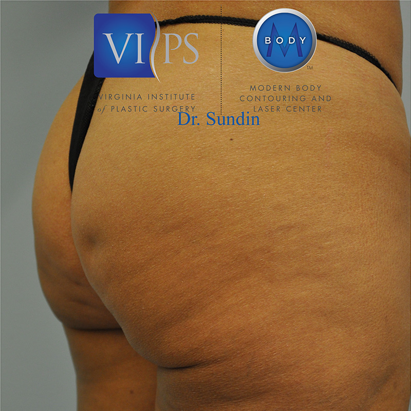 Aveli Before and After | Little Lipo