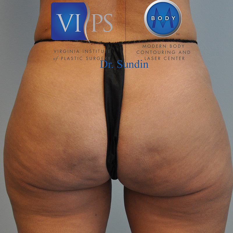 Aveli Before and After | Little Lipo