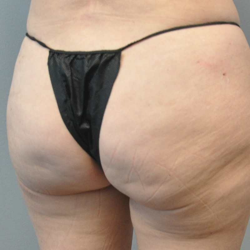 Aveli Before and After | Little Lipo