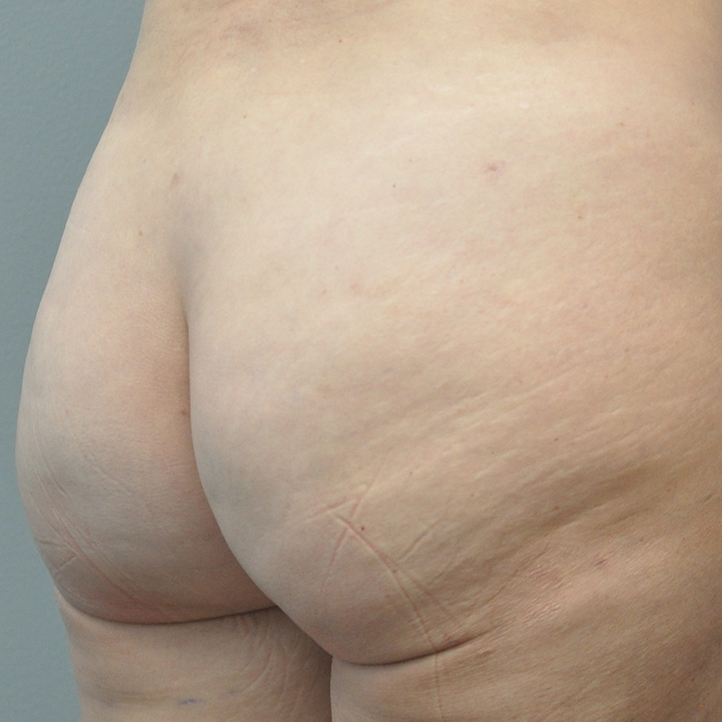 Aveli Before and After | Little Lipo