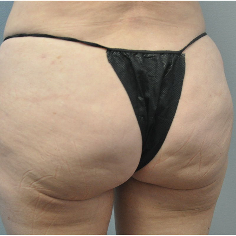 Aveli Before and After | Little Lipo