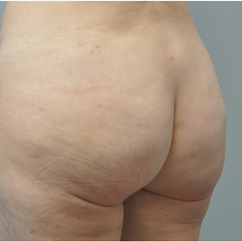 Aveli Before and After | Little Lipo