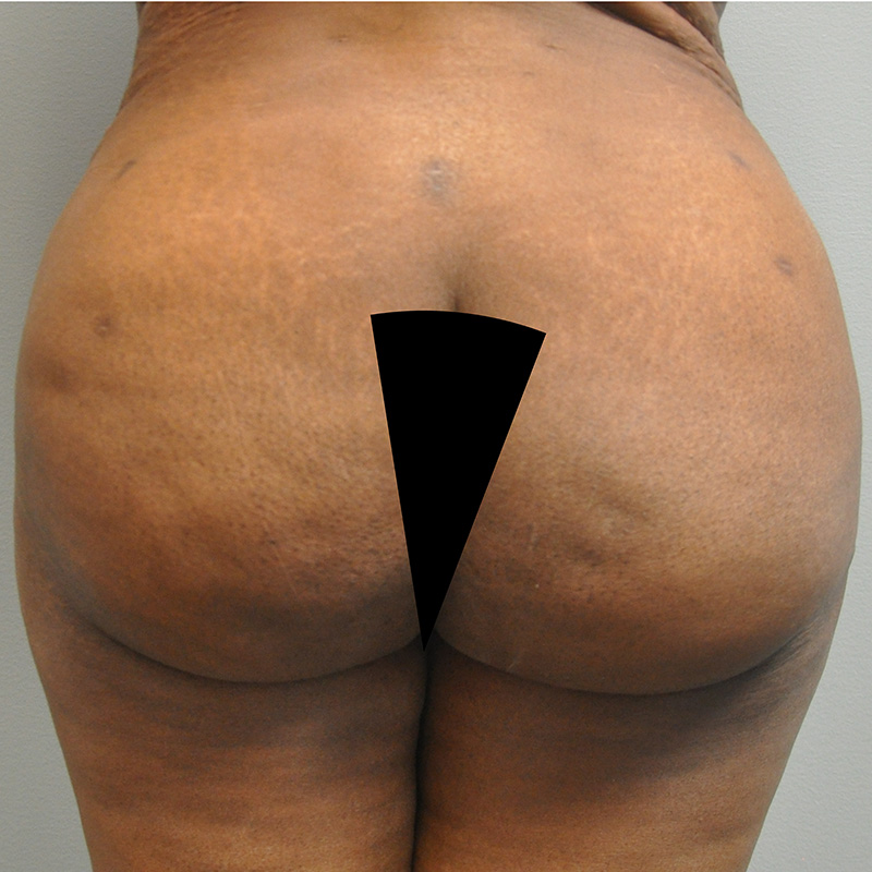 Aveli Before and After | Little Lipo