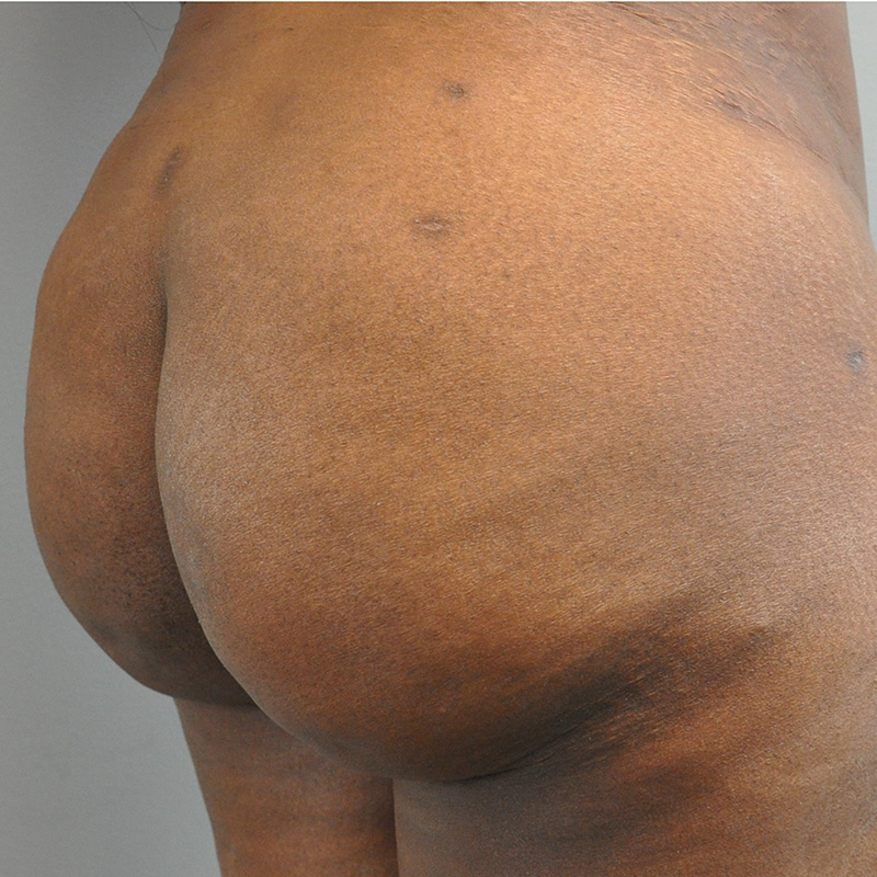 Aveli Before and After | Little Lipo