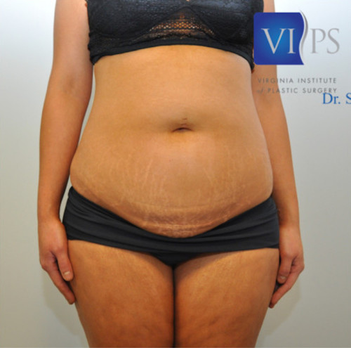 Bodytite Before and After | Little Lipo