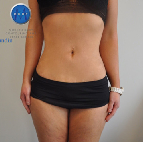 Bodytite Before and After | Little Lipo