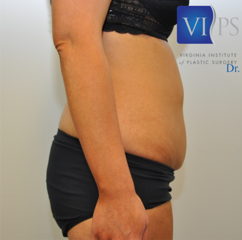Bodytite Before and After | Little Lipo