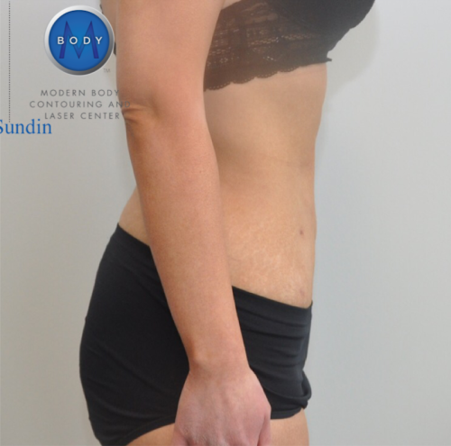 Bodytite Before and After | Little Lipo