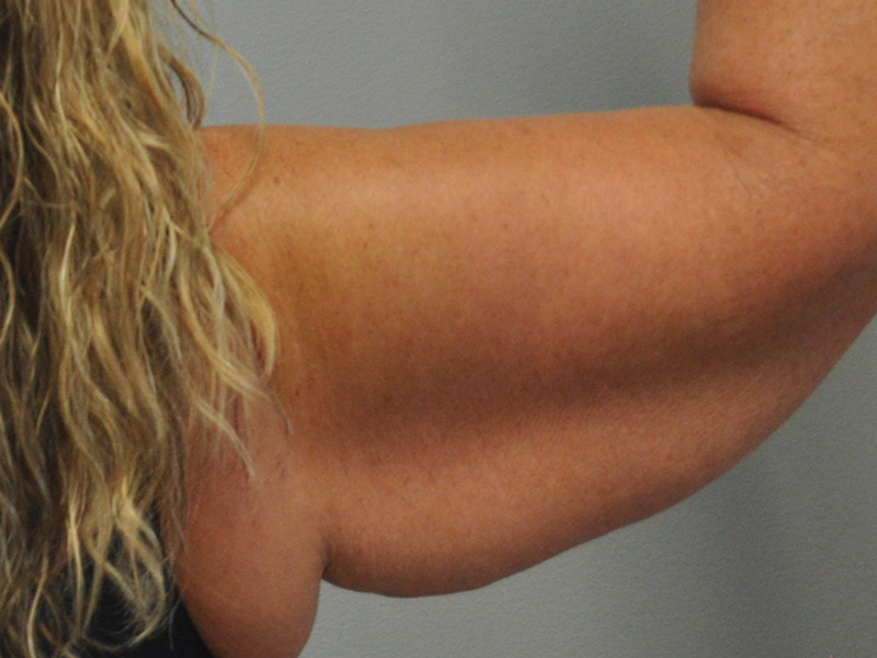 Brachioplasty Before and After | Little Lipo