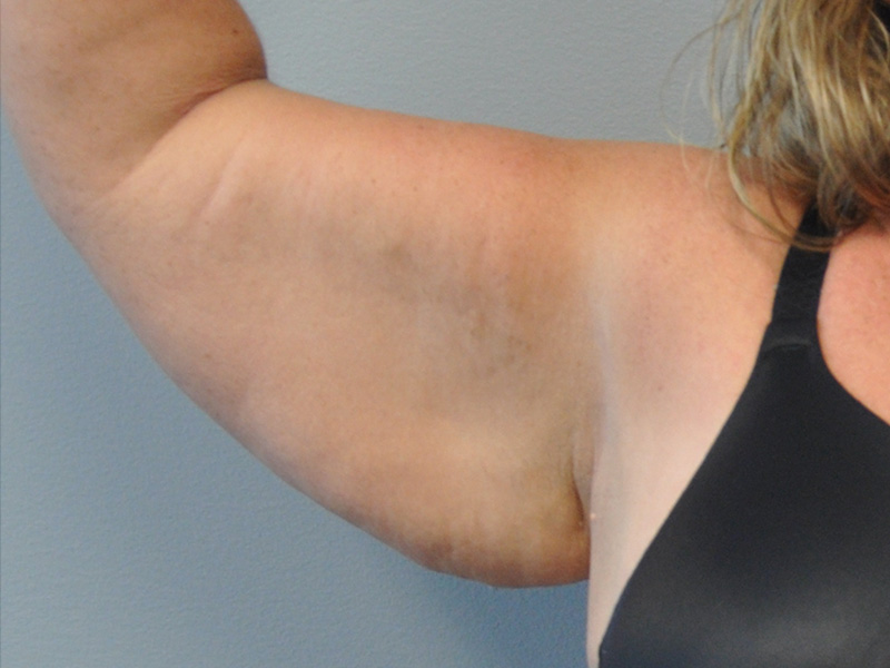 Brachioplasty Before and After | Little Lipo