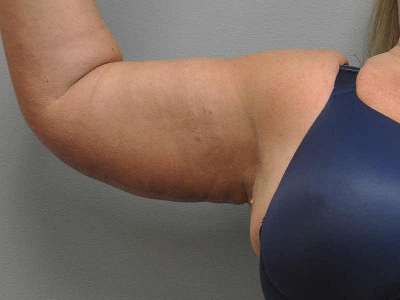 Brachioplasty Before and After | Little Lipo
