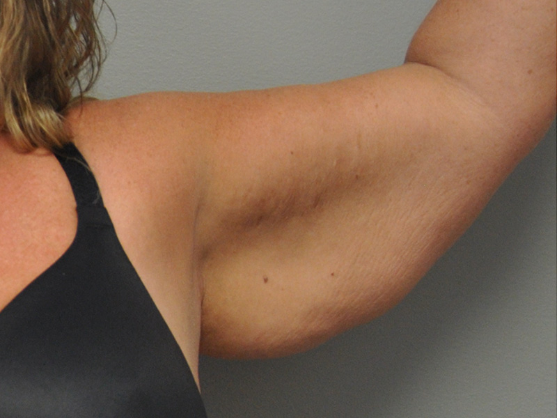 Brachioplasty Before and After | Little Lipo