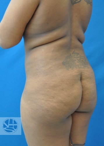 Brazilian Butt Lift Before and After | Little Lipo