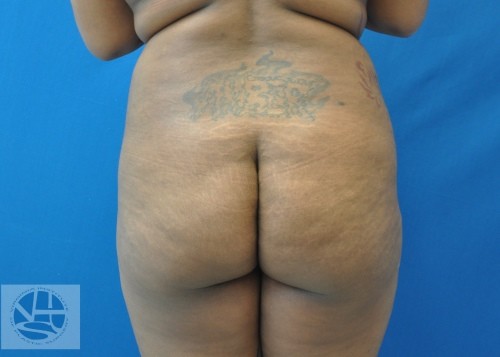 Brazilian Butt Lift Before and After | Little Lipo