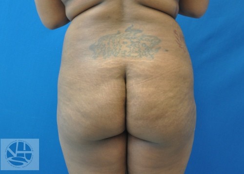 Brazilian Butt Lift Before and After | Little Lipo