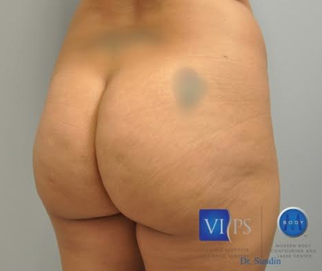 Brazilian Butt Lift Before and After | Little Lipo