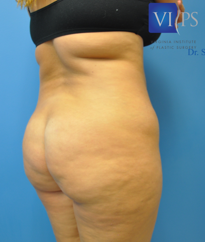 Brazilian Butt Lift Before and After | Little Lipo