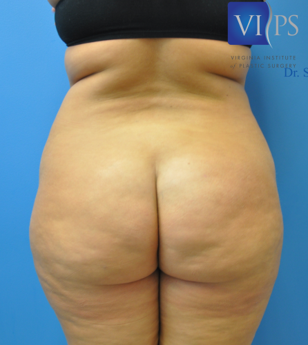 Brazilian Butt Lift Before and After | Little Lipo