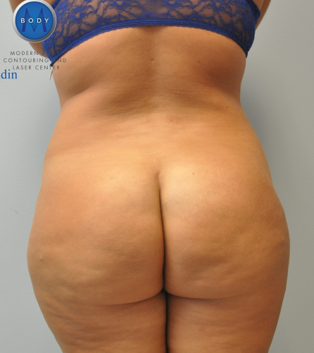 Brazilian Butt Lift Before and After | Little Lipo