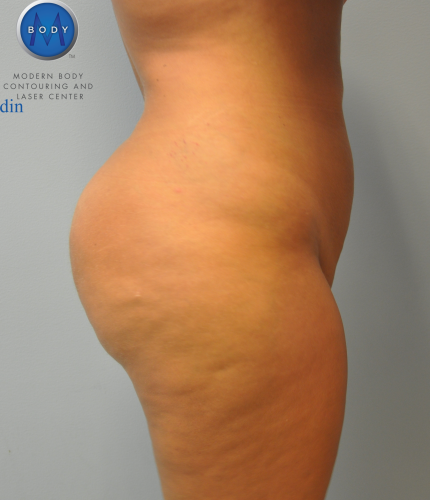 Brazilian Butt Lift Before and After | Little Lipo