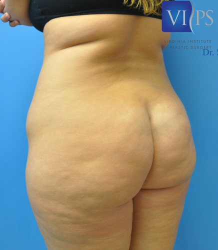 Brazilian Butt Lift Before and After | Little Lipo