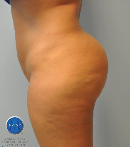 Brazilian Butt Lift Before and After | Little Lipo