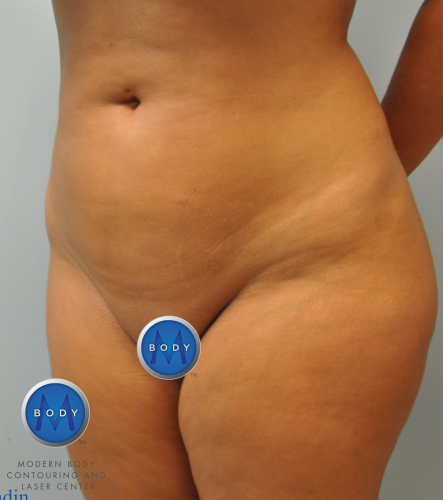 Brazilian Butt Lift Before and After | Little Lipo