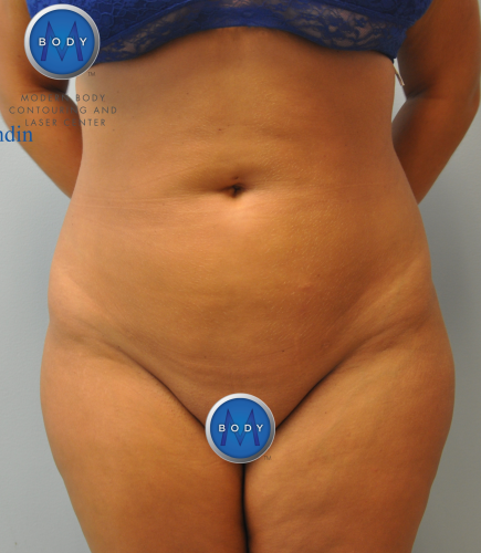 Brazilian Butt Lift Before and After | Little Lipo