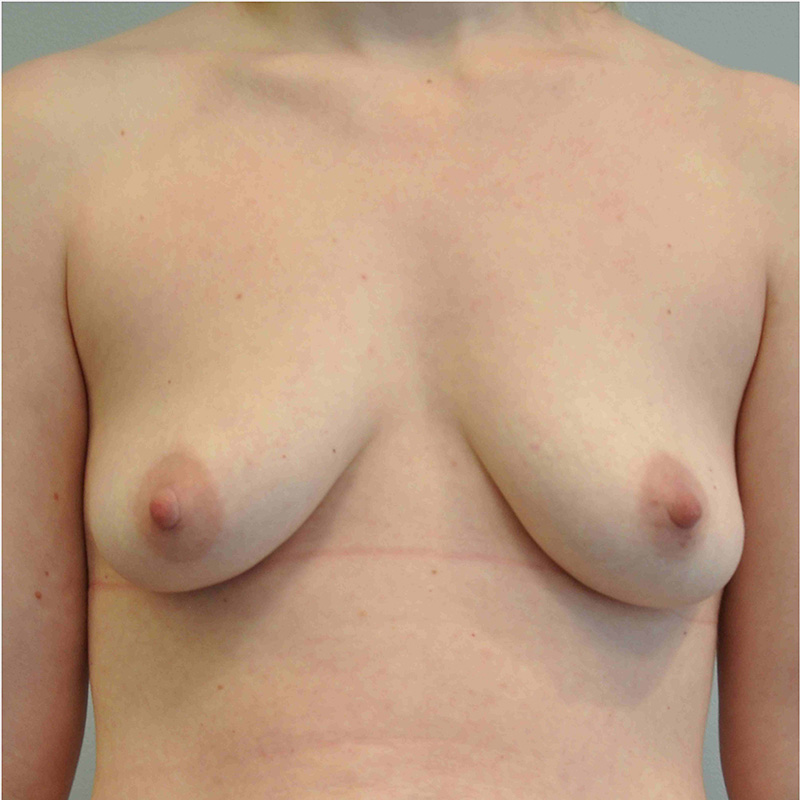 Breast Augmentation With Fat Grafting Before and After | Little Lipo