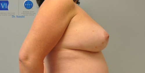 Breast Augmentation With Fat Grafting Before and After | Little Lipo