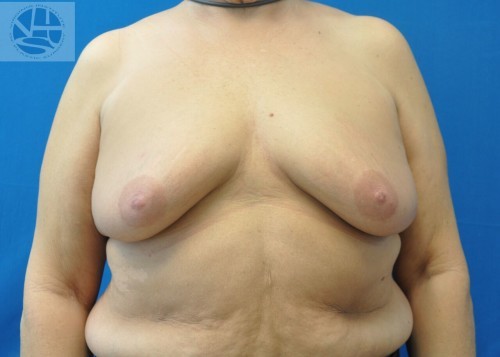 Breast Augmentation With Lift Before and After | Little Lipo