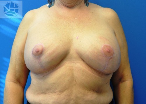 Breast Augmentation With Lift Before and After | Little Lipo