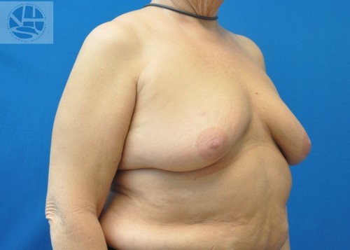 Breast Augmentation With Lift Before and After | Little Lipo