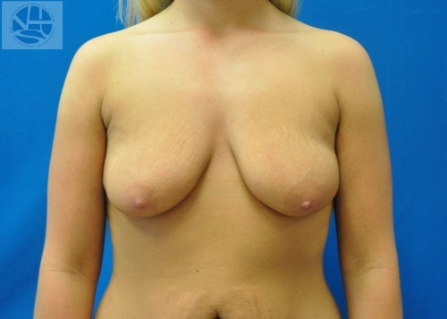 Breast Augmentation With Lift Before and After | Little Lipo