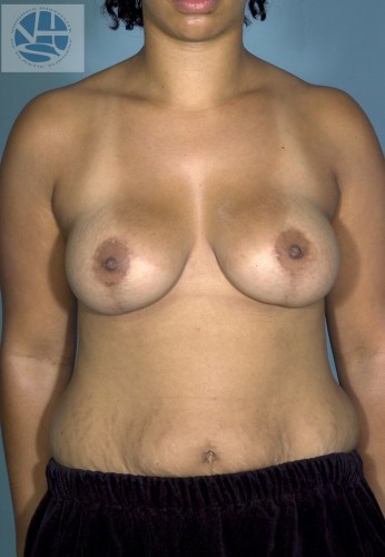 Breast Augmentation With Lift Before and After | Little Lipo