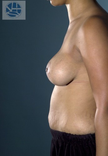 Breast Augmentation With Lift Before and After | Little Lipo