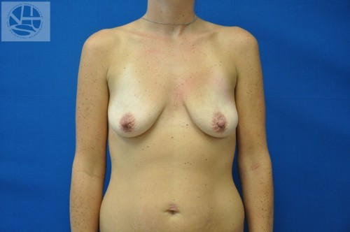 Breast Augmentation With Lift Before and After | Little Lipo