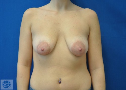 Breast Augmentation With Lift Before and After | Little Lipo