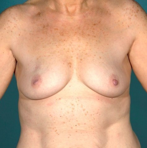 Breast Augmentation With Lift Before and After | Little Lipo