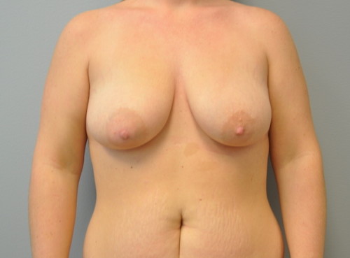 Breast Augmentation With Lift Before and After | Little Lipo