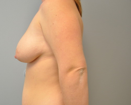 Breast Augmentation With Lift Before and After | Little Lipo