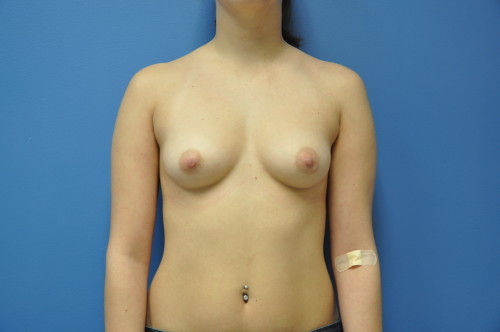 Breast Augmentation Before and After | Little Lipo